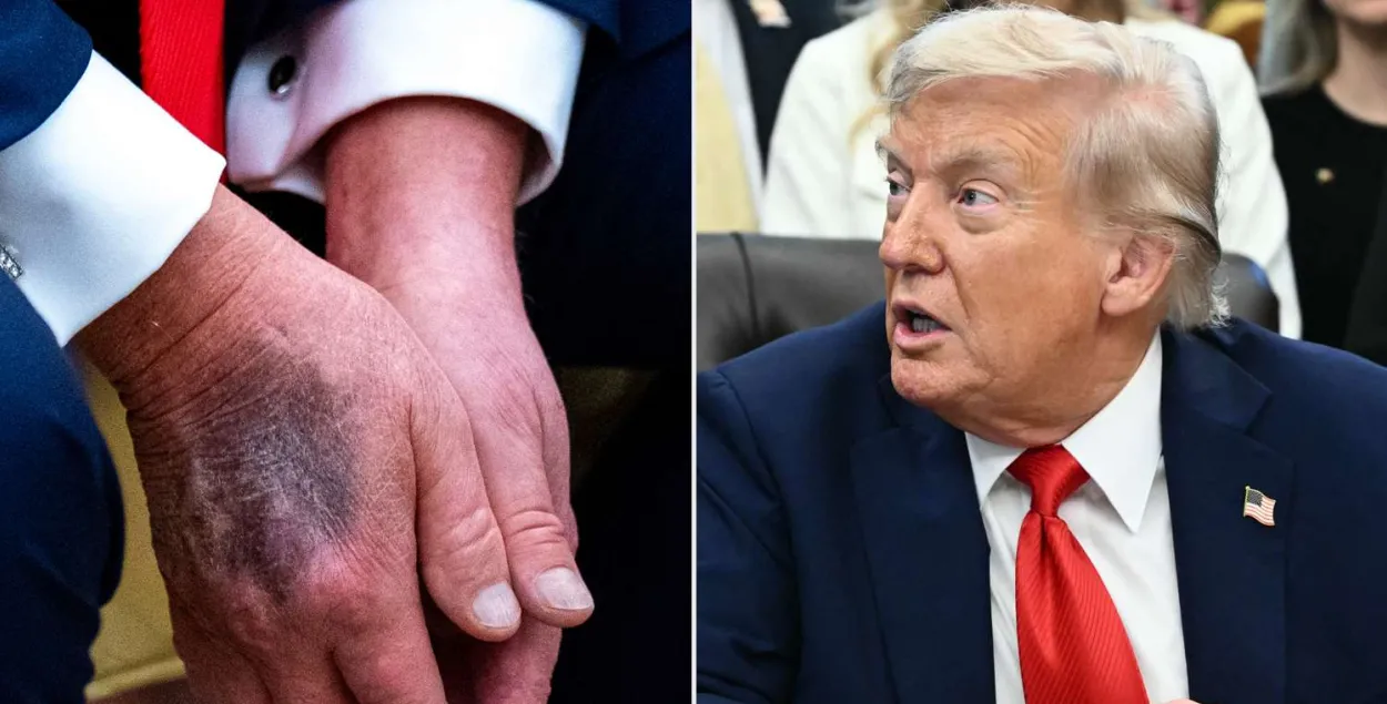 Сінякі на руках Трампа непакояць дактароў
