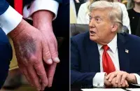 Синяки на руках Трампа беспокоят врачей
