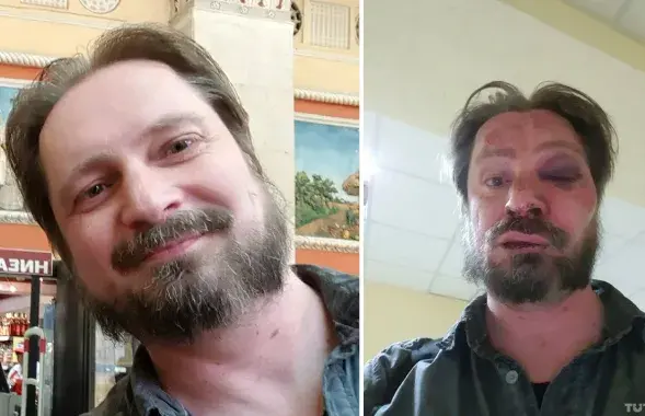Siarhei Chaly before and after the attack. Photo: Euroradio/TUT.by