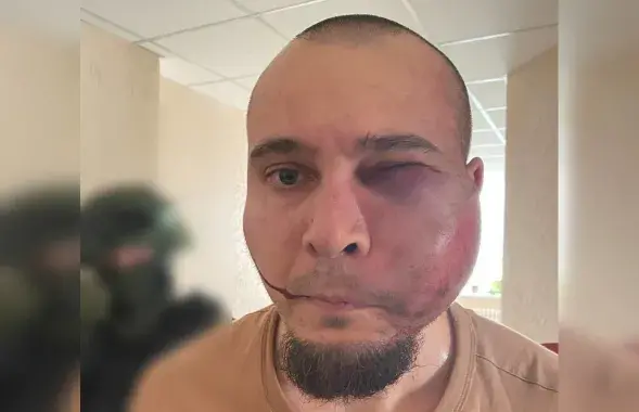 Избитый силовиками витебчанин
