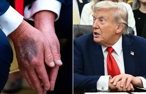 Синяки на руках Трампа беспокоят врачей
